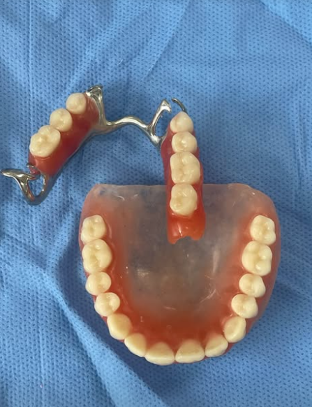 Prótese dentária confeccionada pela Dra. Mariana Braz
