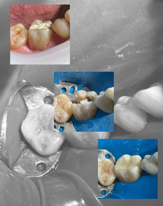 Etapas de restauração dentária realizada pela Dra. Mariana Braz